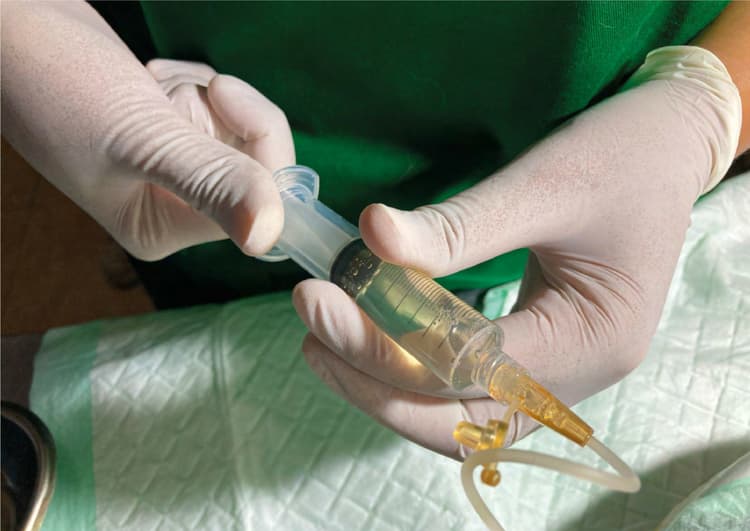 I versamenti cavitari e la gestione del post-operatorio con nutraceutici