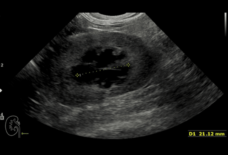 Idronefrosi bilaterale in un gatto: caso clinico